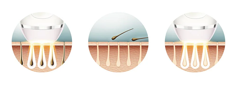 hoe lang resultaat met ontharen door IPL